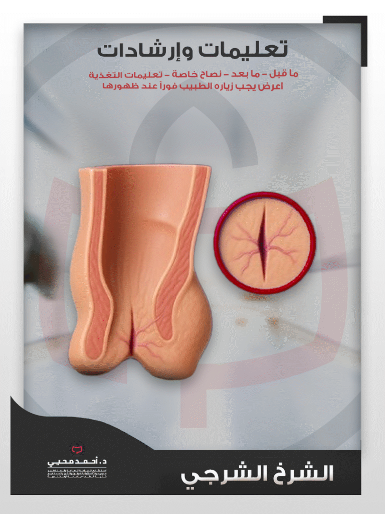 الشرخ الشرجي